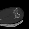 SPORK, NICO - 22.03.1976 - 02.08.2022 - CT obere Extremität - 18:02:23